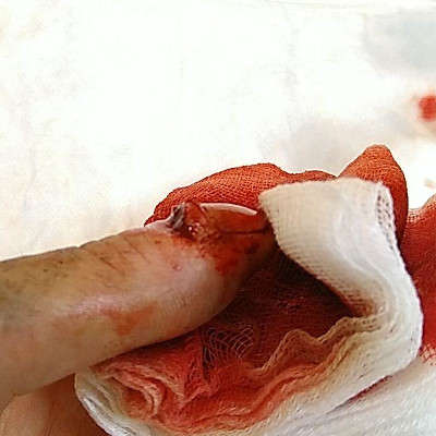 Photo de la fracture ouverte