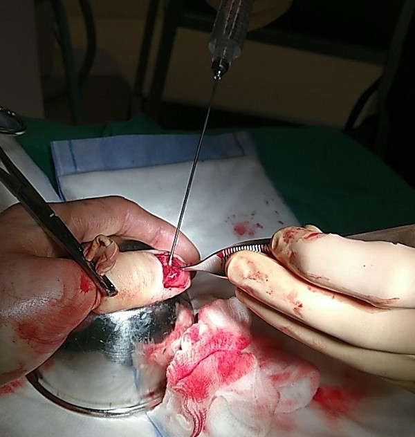 Nettoyage de la plaie