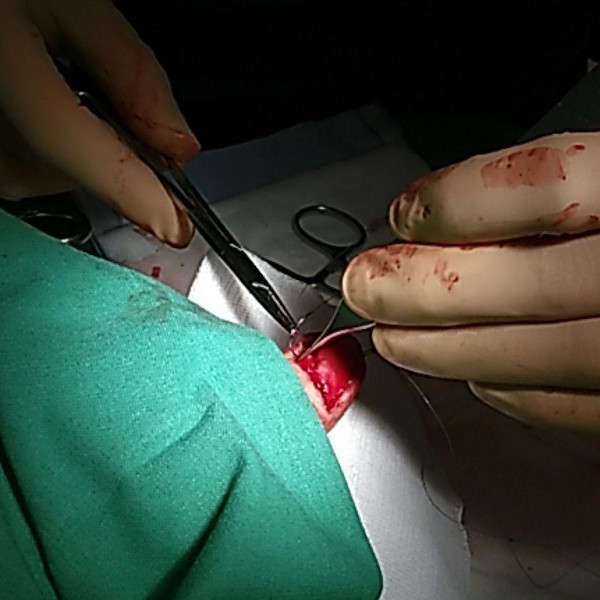 Début de la couture de la plaie