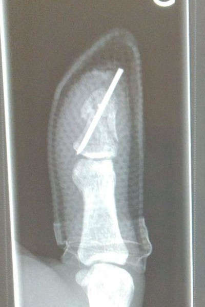 La radio après 3 semaines