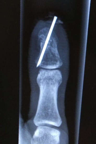 La radio avant l'ablation