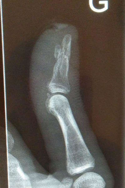 La radio après l'ablation