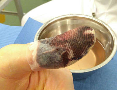 Le pansement ensanglanté