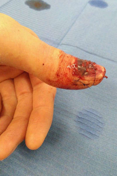 L'état du doigt après 5 jours