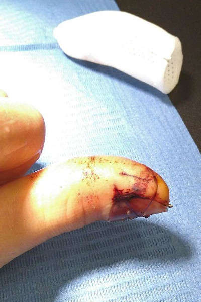 L'état du doigt après 12 jours