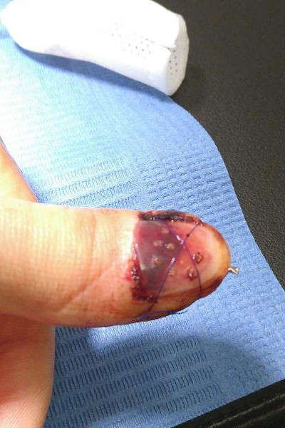 L'état du doigt après 12 jours