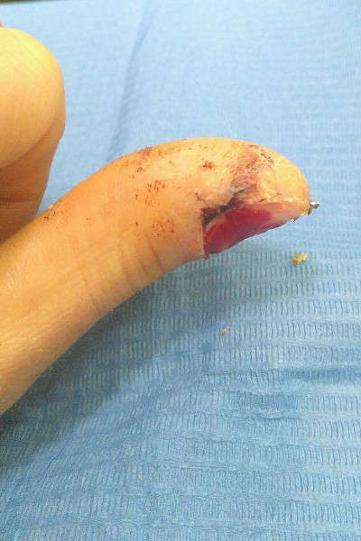 Le doigt sans faux ongle