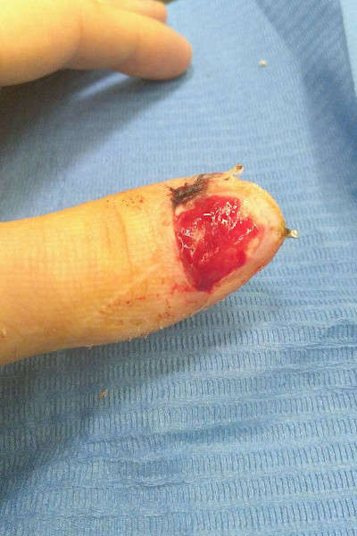 Le doigt sans faux ongle