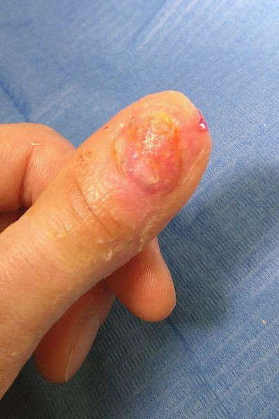 Le pouce sans la broche