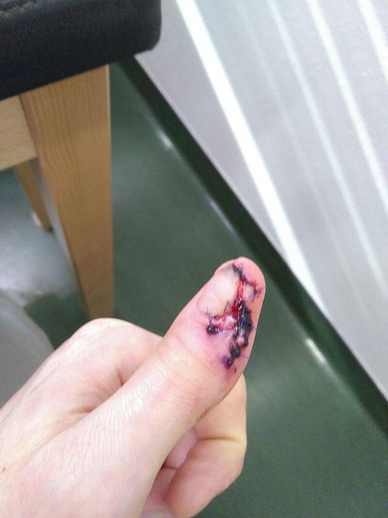 Les points de sutures