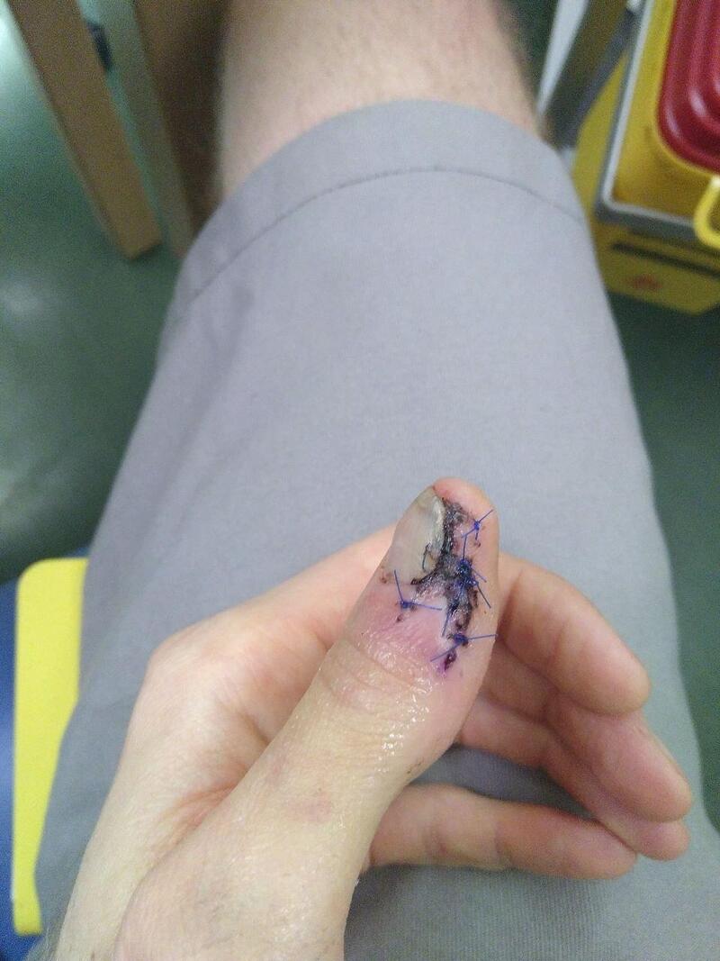 Pouce en phase de guérison