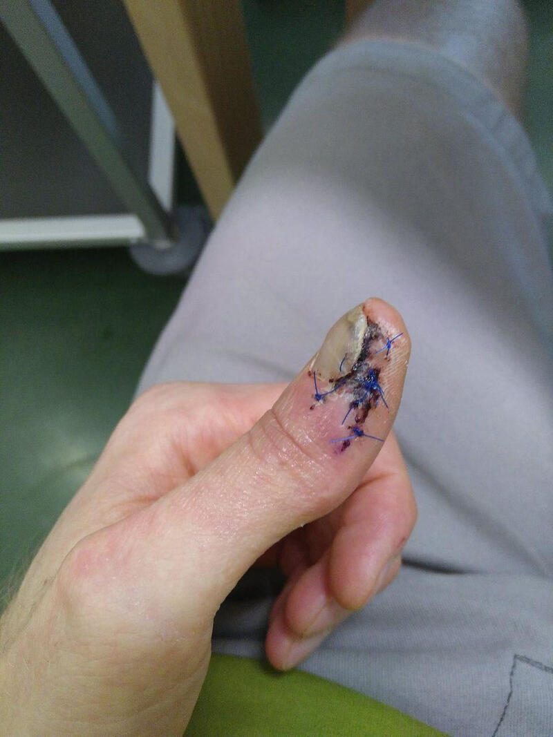 Pouce en phase de guérison